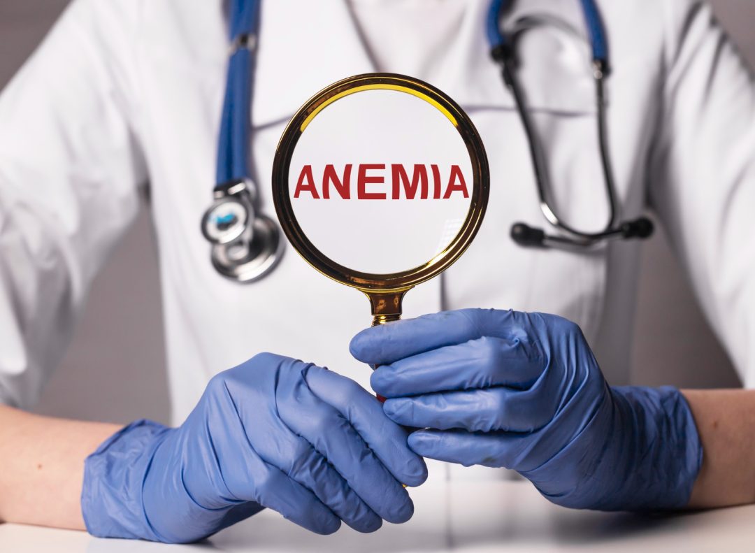 Treating Anemia From Iron Deficiency in Dubai